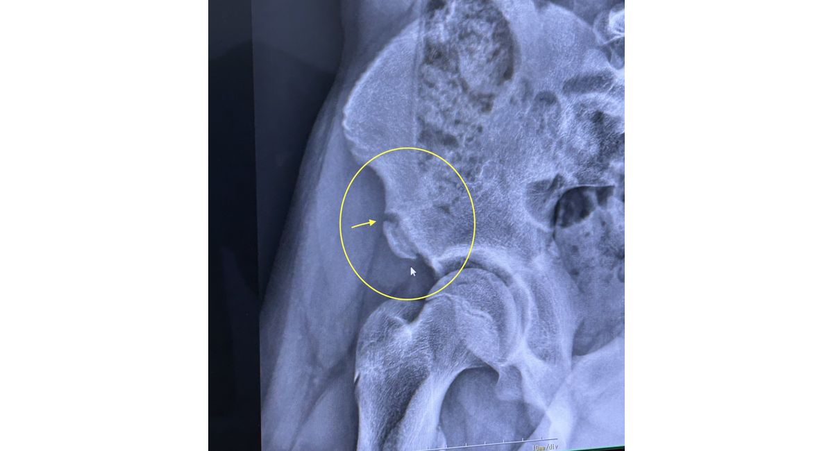 骨盤の骨折・下前腸骨棘骨折の超音波治療（リーパス）の症例