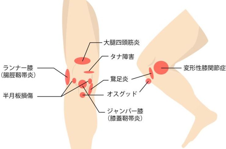 茅ヶ崎駅徒歩４分のチガサキ整骨院のオスグッドの原因と対応方法をご紹介。長引くオスグッドの痛み、再発するオスグッドの痛み、安静にしても・ストレッチをしても改善しない痛み、運動を休まなければならないオスグッドの痛みでお困りの方は、チガサキ整骨院の整体で改善。今すぐご相談ください！